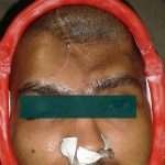 Prostho-cranial-Implant-1-150x150