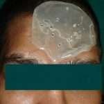 Prostho-cranial-Implant-2-150x150